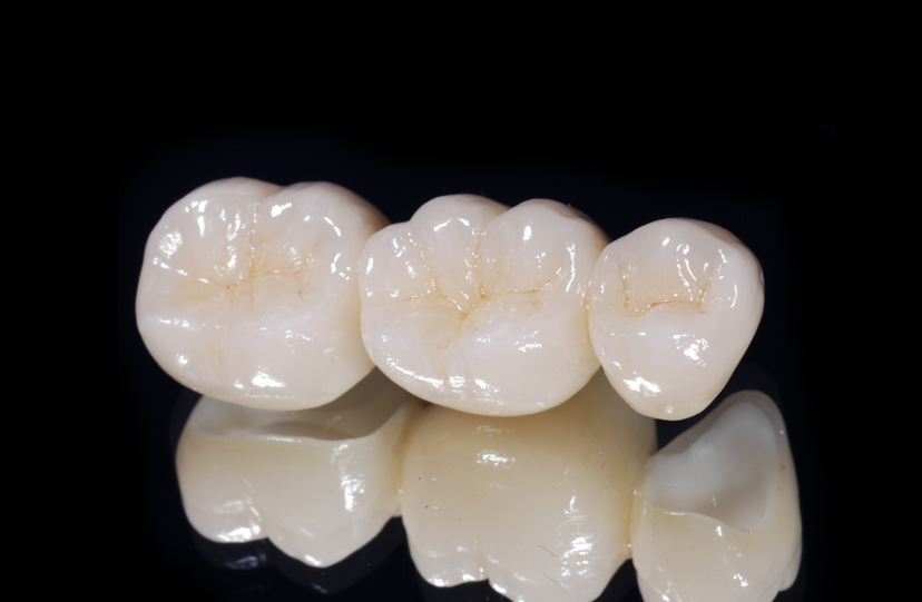 Non-Veneered Zirconia